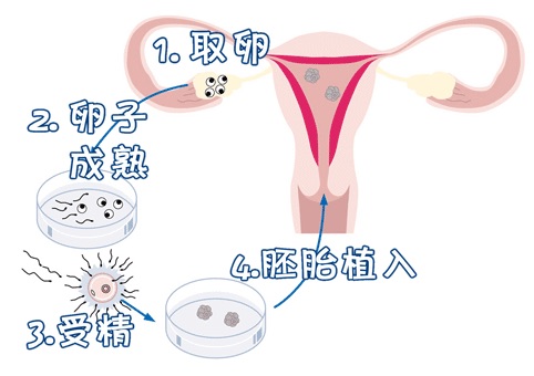 反复流产